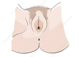 Maybe you would like to learn more about one of these? Female Circumcision Keyword Search Science Photo Library