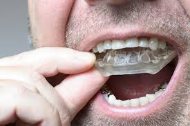 How Often Should You Replace Your Night Guard for Teeth Grinding?