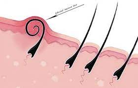 Ingrown hair can also be infected by bacteria and develop into painful boils that are known as razor bumps. Ingrown Hair Infection Boils Staph Pictures Treatment Removal