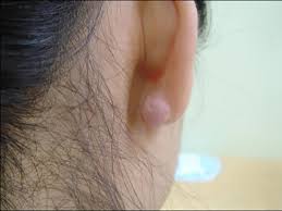 Soak the piercing with a medicine cup, shot glass or saturated gauze pad for 10 minutes. Keloid On Ear Causes Treatment And Prevention