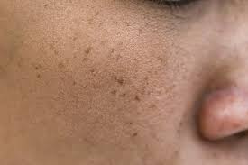 Image result for Freckled skin