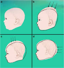 To give your newborn a sponge bath, dermatologists recommend. Cranial Molding On Neonates In Ghana Mothers Perspective And Their Knowledge On Potential Harm To Babies Brain Springerlink