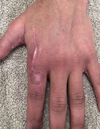 Image result for Hand Injury