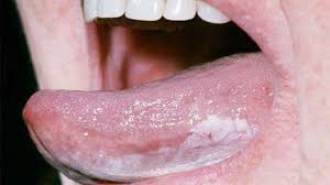 Image result for brown tongue symptoms
