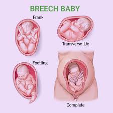 Image result for Breech Delivery