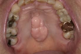 They appear little white or yellow bumps on gums and roof of mouth. Yikes What Is That Lump In My Mouth Julie M Gillis Dds