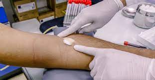 We did not find results for: Bruising After Blood Draw Why What To Do And Prevention