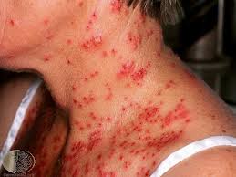 Type 2 hsv is more often symptomatic than type 1 hsv. Eczema Herpeticum Cause Symptoms Treatment Prevention