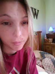 Natural remedies for scar healing after surgery