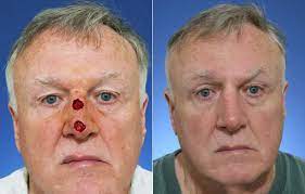 Its superiority over other techniques lies in the precise removal of an invasive tumor that may twist and tunnel under the skin, and remain unnoticed by the normal eye. Mohs Surgery Santa Barbara Mohs Reconstruction Dr Sheffield
