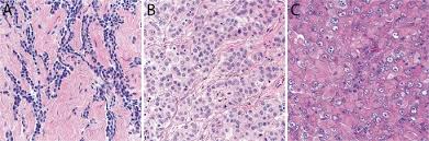 Maybe you would like to learn more about one of these? Malignant Peritoneal Mesothelioma Prognostic Significance Of Clinical And Pathologic Parameters And Validation Of A Nuclear Grading System In A Multi Institutional Series Of 225 Cases Modern Pathology