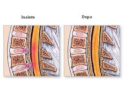 Exerciții pentru tratamentul hernie de disc 1. Hernie De Disc Cervicala Exercitii