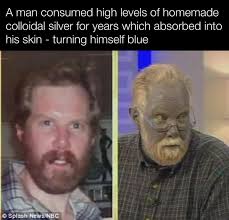 There is a real life medical condition called argyria or argyrosis which is  caused by excessive exposure to silver dust or chemical compounds  containing silver. It has the unique symptom that it