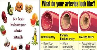 18 Foods That Clear The Arteries And Prevent Heart Attack Arteries Heart Healthy Meals Plan Prevent Heart Attack
