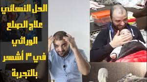 علاج الصلع الوراثي تجربتي وسر نجاحها Hair Thumbs Up