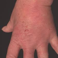 Image result for erysipel photos)