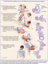 Epley Maneuver Mum Physical Therapy Exercises Vertigo