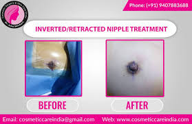 Image result for Nipple Inversion