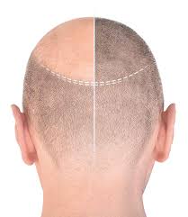 Obesity continues to be a major health concern in the western society. Hair Transplant Estecapelli