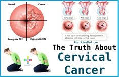 Symptoms may be caused by something other than cancer, but the only way to know is to see a doctor. Cervical Cancers