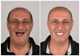 3899-dental-implants-replacement-alluredental