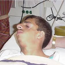 PDF) Transversus abdominis plane block as a sole anesthetic technique for  open appendectomy in patient with Treacher Collins syndrome: a case report