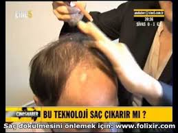 Sac Dokulmesine Kesin Cozum Folixir Prof Dr Meral Sasoglu Youtube Sac Youtube Teknoloji