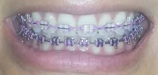 Currently In Braces After A Year Brampton On Dental Braces Braces Colors Cute Braces