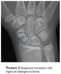 Image result for Scaphoid Fracture Signs