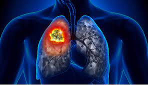 If you have shortness of breath it is possible that you have other problems which can be associated with the heart or the lung (such as copd if you have history of smoking), but. Blog 7 Facts You Need To Know About Lung Cancer Nfcr