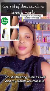 Happy Event for Stretch Marks at Clicks