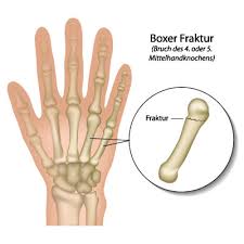 Mittelhandknochenbruch Ursachen Symptome Behandlung Medlexi De