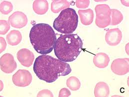 Hospital german trias i pujol, barcelona. Leucemia Linfoblastica Aguda Del Nino Y Del Adolescente Clinica Y Tratamiento Sciencedirect