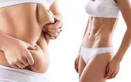 Liposuction in Islamabad: Cost,Recovery &amp;amp; Expert Surgeon