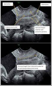 Guideline No 401 Sonographic Cervical Length In Singleton Pregnancies Techniques And Clinical Applications Journal Of Obstetrics And Gynaecology Canada