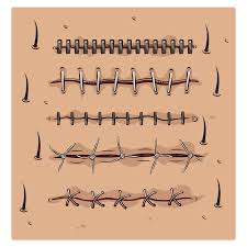 الخياطة التجميلية بعد الولادة الاسعار و الأنواع تجميلي