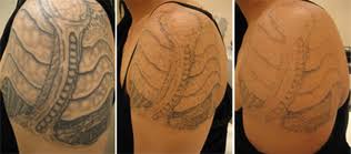 During surgical, or excision, tattoo removal, a surgeon will cut off your tattooed skin and sew your remaining skin back together. Tattoo Removal Sin On Skin Tattoo Studio
