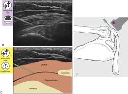 Image result for Subacromial Space Injection