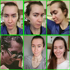 Daily hairstyles for reducing reclining hairline female : How Can I Fix Regrow My Hairline Beauty