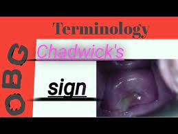 The chadwick sign is also known as the jacquemier sign. it's characterized by a violet or dark blue tone of the vaginal mucosa and cervix. Jacquemier S Or Chadwick S Sign By Vivekanand Mishra Youtube