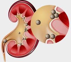 Eliminați colicul rinichiului este capabil doar de narcotice. Tratamente Naturiste Pentru Pietre La Rinichi Cauze Si Simptome