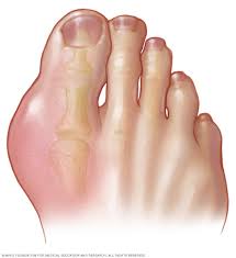 Image result for gout symptoms toe