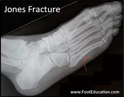 Jones Fracture - Footeducation