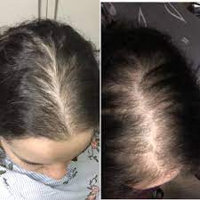 Results Of 3 Months Minoxidil 5 Once Per Day Nizoral Shampoo And Perhaps Also Diet And Exercise And An Increase In Metformin Not Sure Exactly What Type My Hairloss Is But