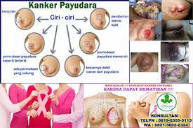 Di payudara saya sebelah kiri ada benjolan namun tidak sakit saat ini saya minum minyak habbatussauda, minyak zaitun, dan madu 1 sendok apakah sahabat sehat pernah merasakan ada benjolan pada payudara ? Benjolan Di Payudara Kanan Sakit Bila Ditekan