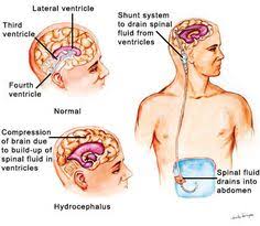 Ventriculoperitoneal Vp Shunt Best Hospitals Drs Cost Medgurus