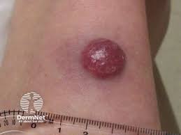 Image result for Merkel Cell Carcinoma