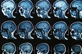 Pour Tout Savoir Sur L Accident Vasculaire Cerebral