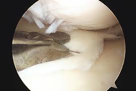 Wird der innenmeniskus verletzt, so handelt es sich zumeist um einen anriss oder einen kompletten abriss. Operation Meniskusriss