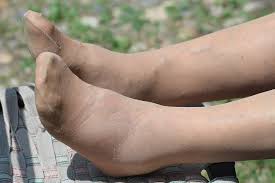 Cuci bersih 50 gram meniran segar. Mengatasi Kaki Bengkak Secara Cepat Dengan 5 Bahan Alami Ini